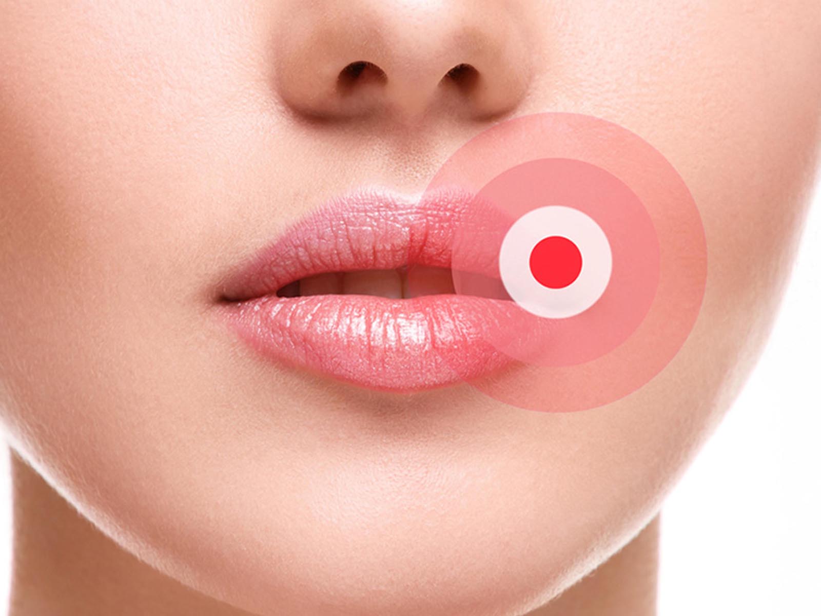 Cold Sore Treatment Services