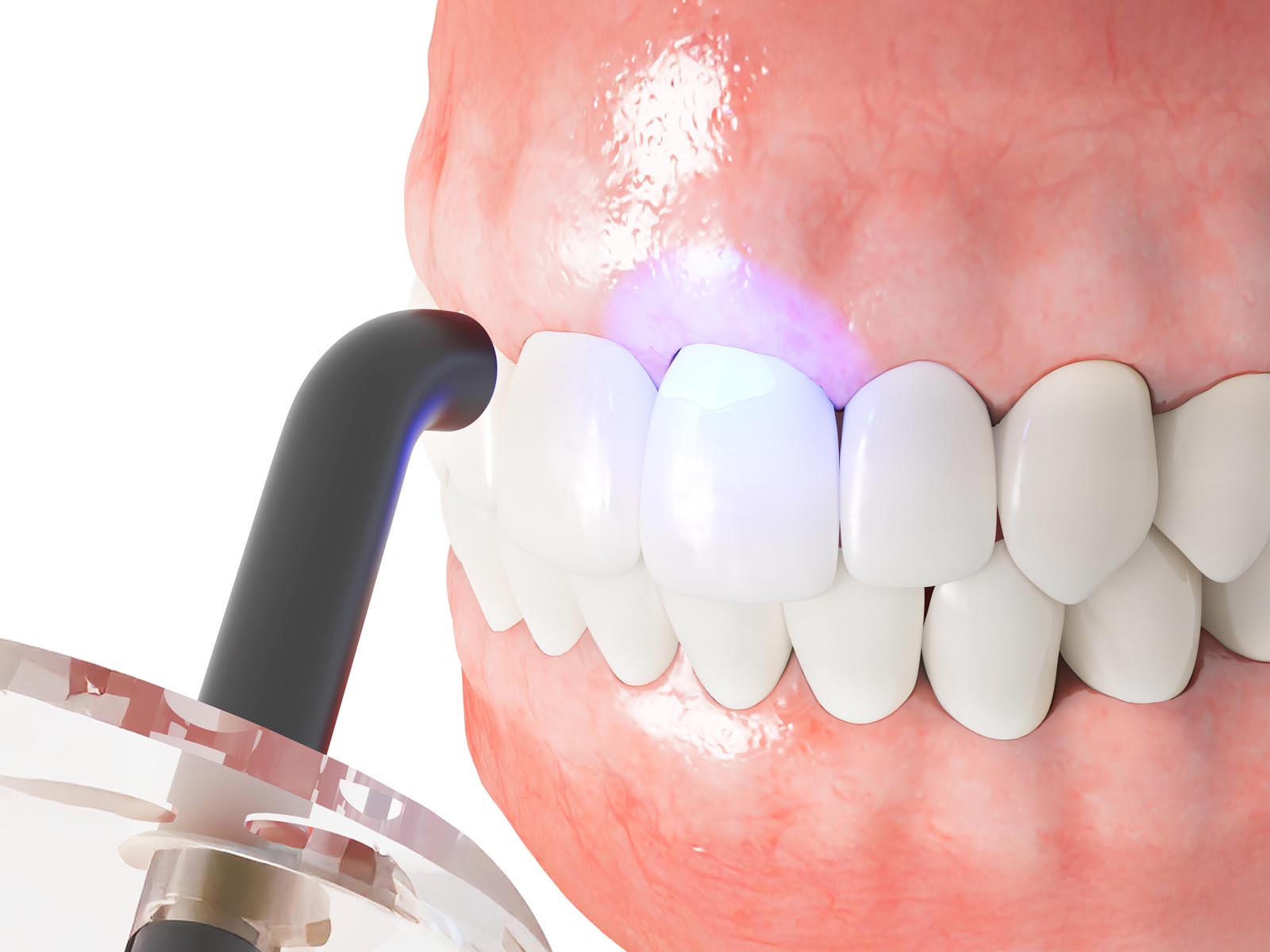 Dental Bonding Services