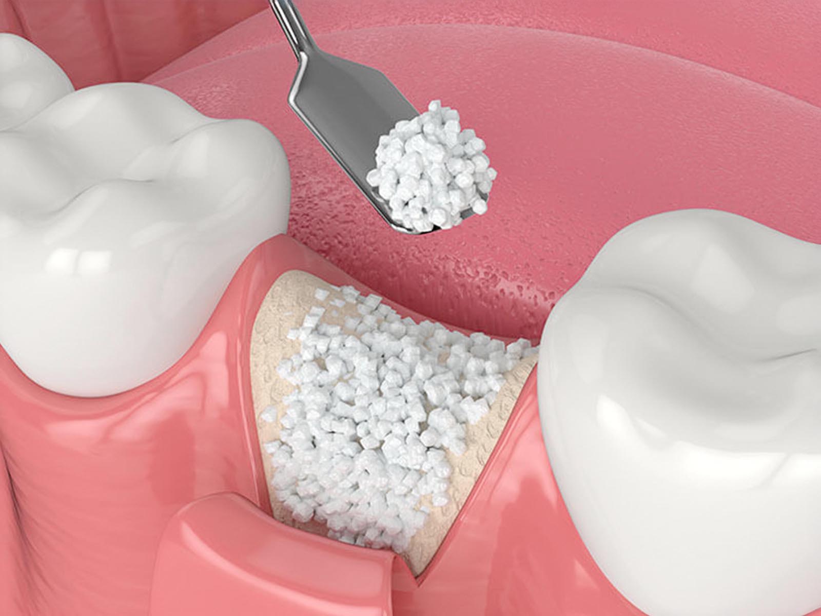 Dental Bone Grafting Services