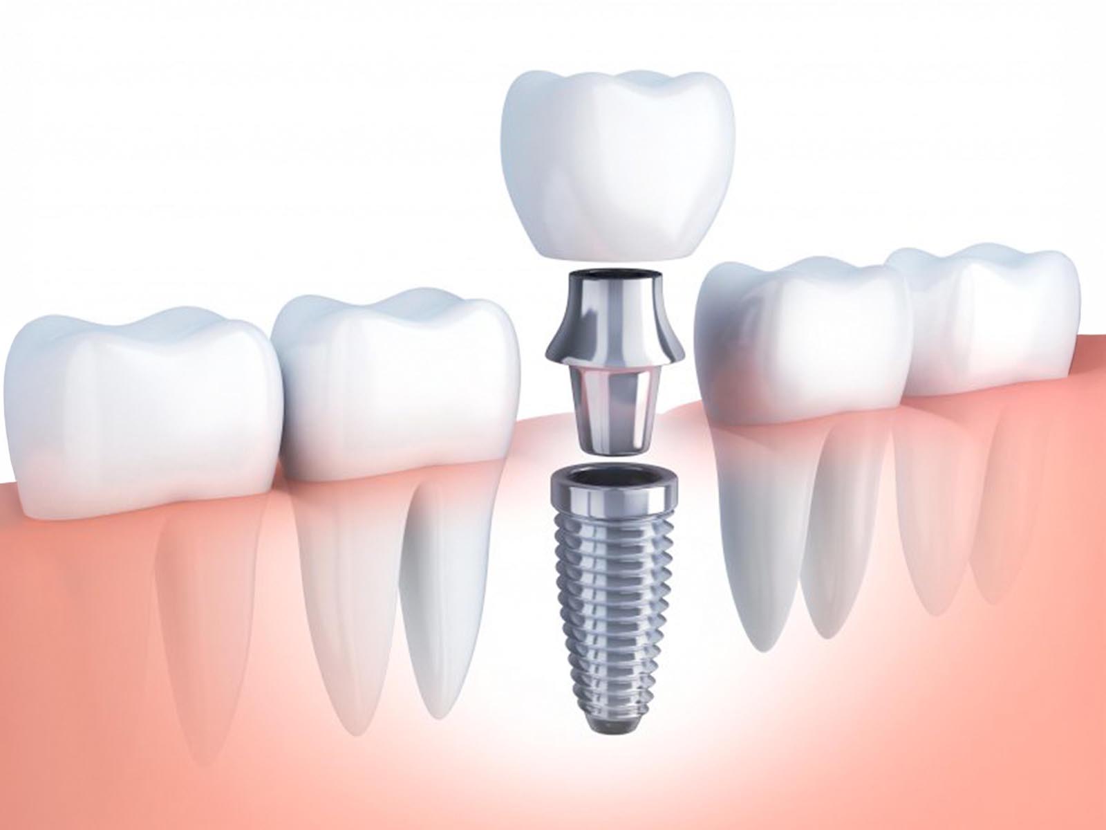 Dental Implants Services