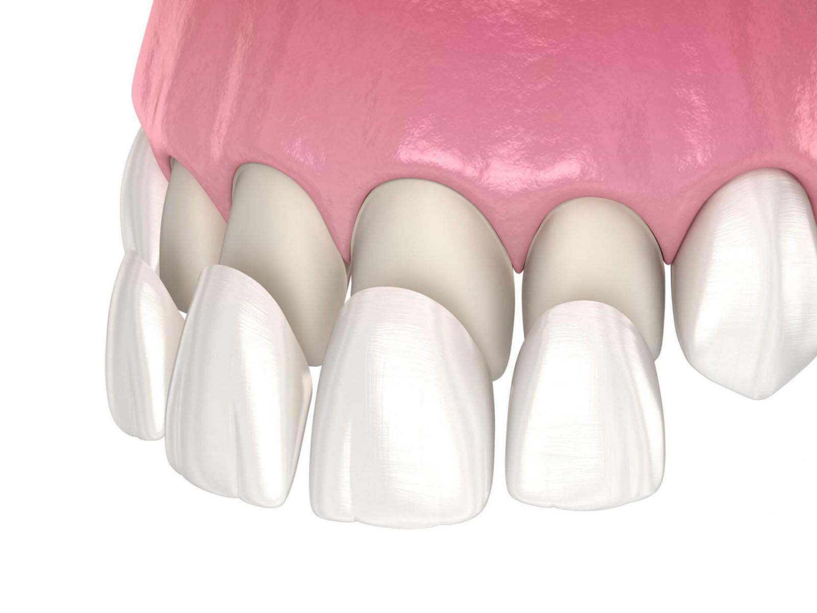 Dental Veneers Services