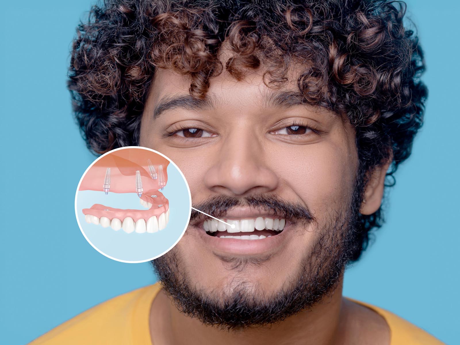 Full Mouth Dental Implants Services