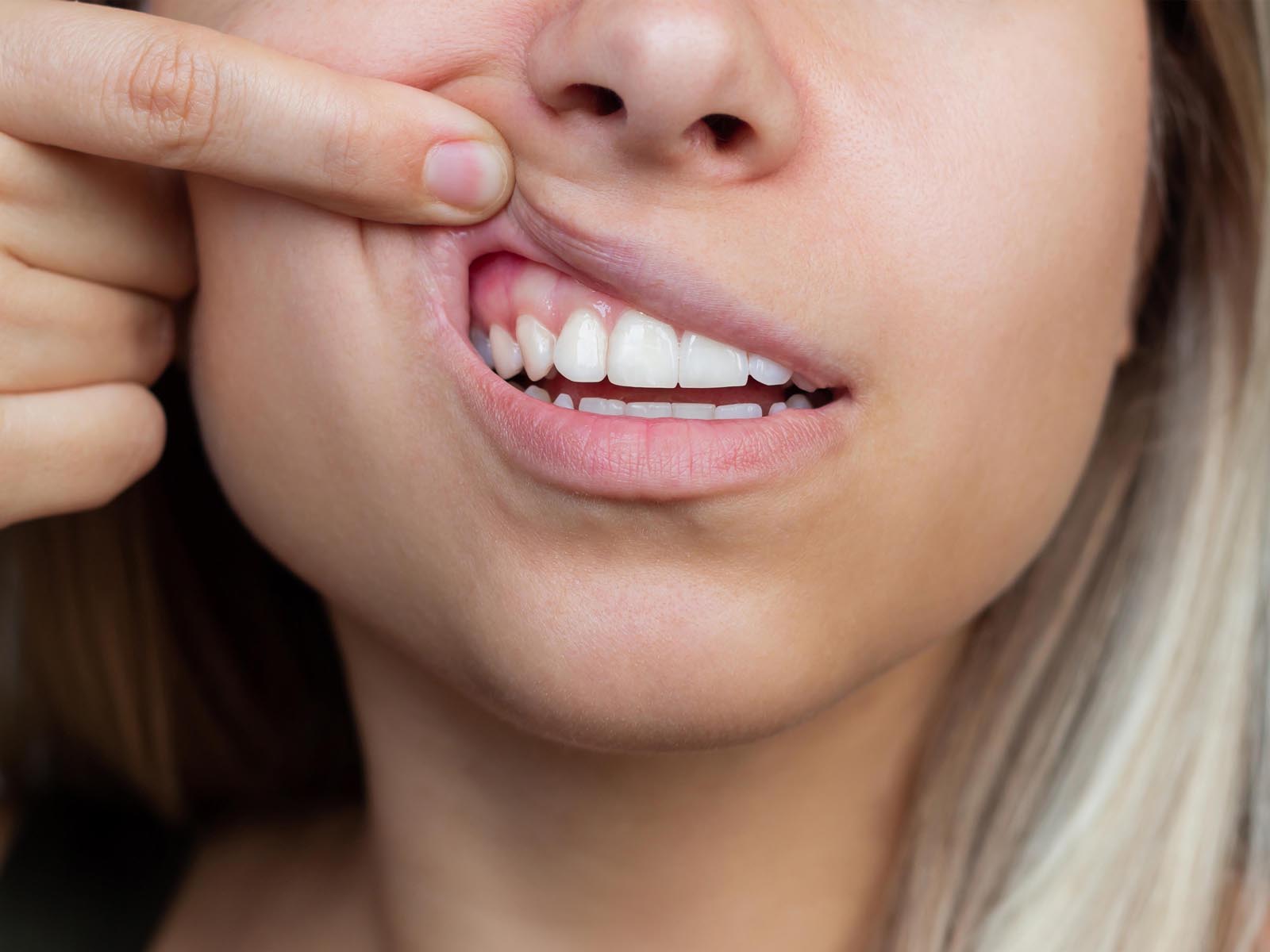 Gum Grafting Services