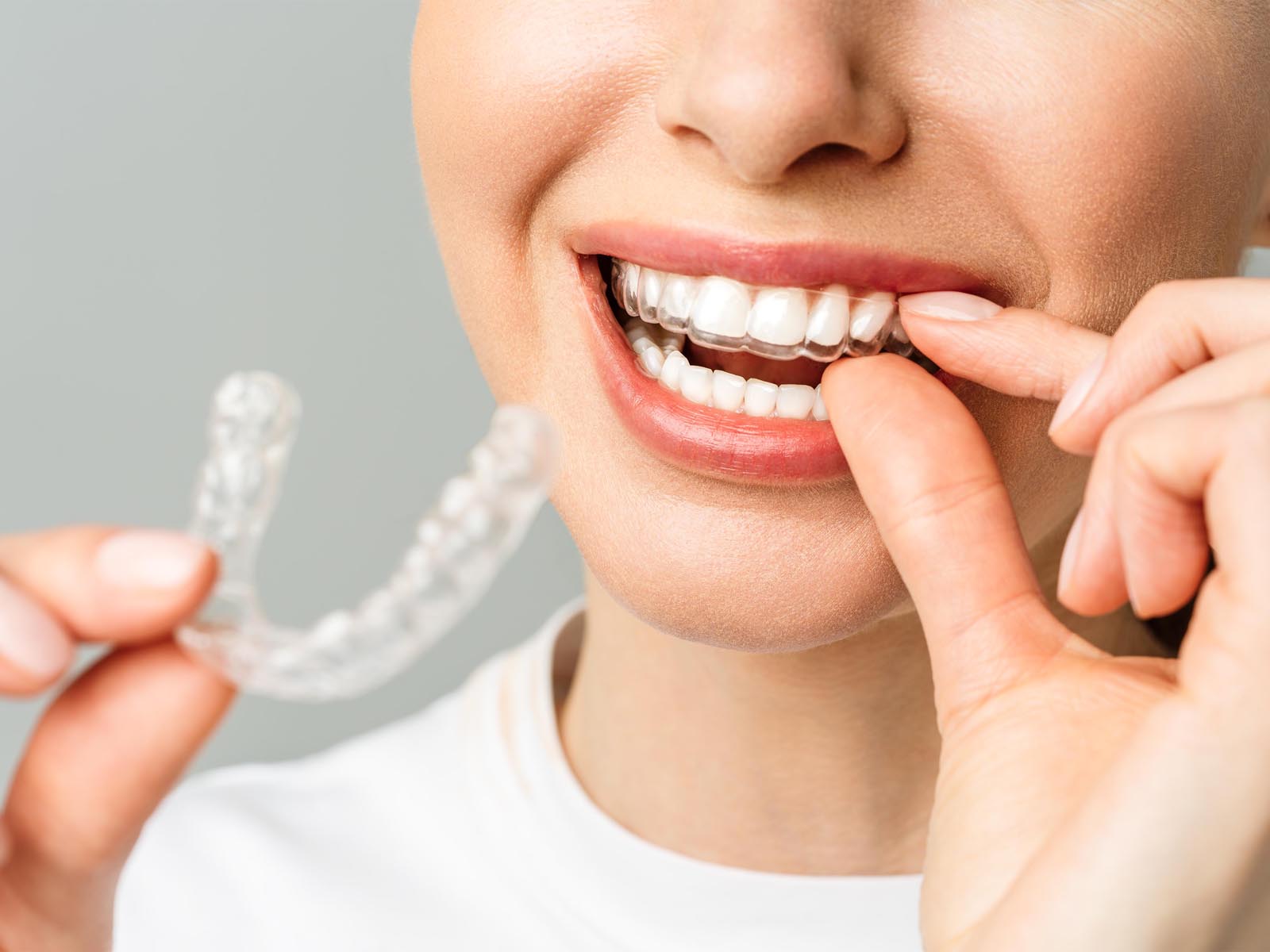 Invisalign Services