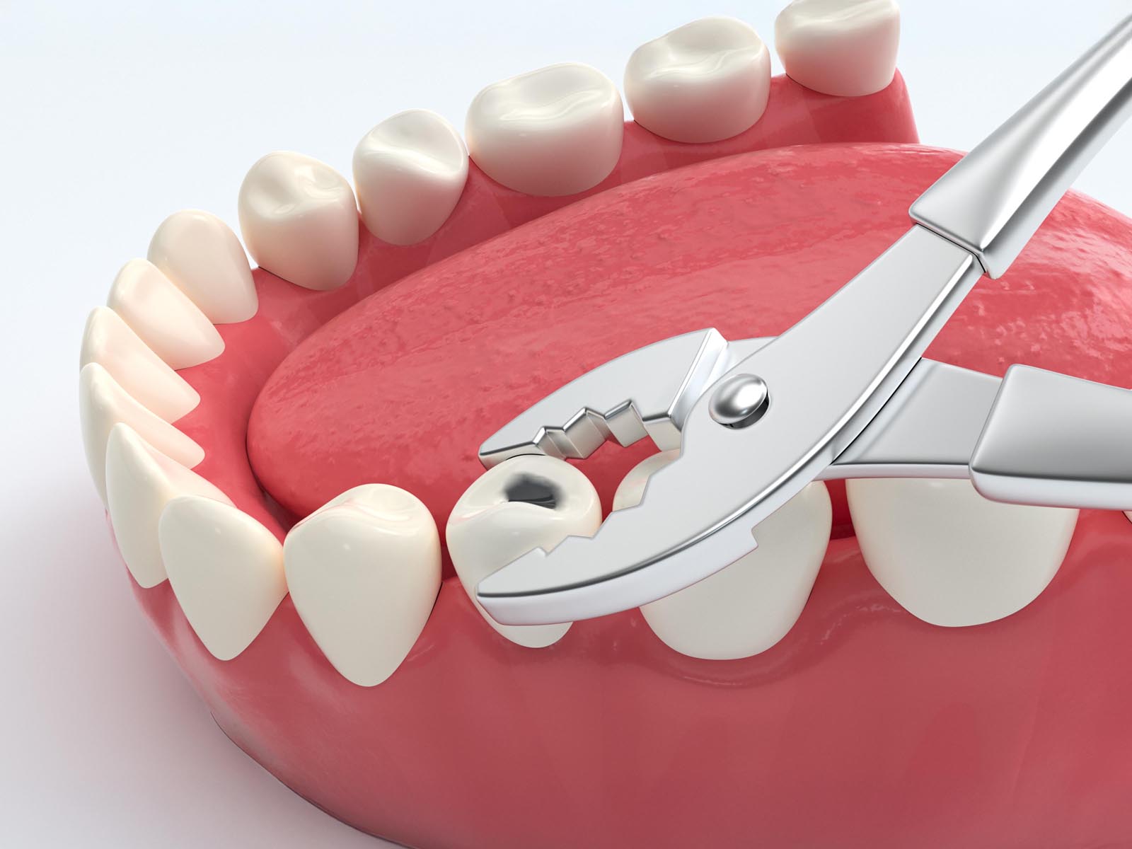 Tooth Extraction Services