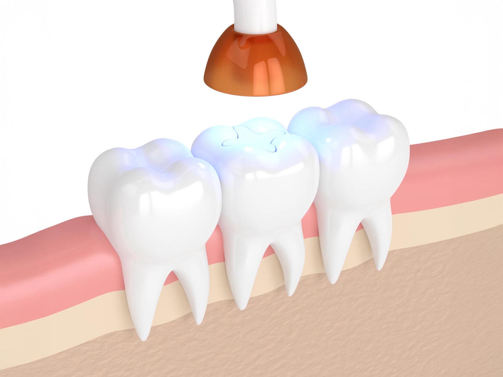 Tooth Fillings Services