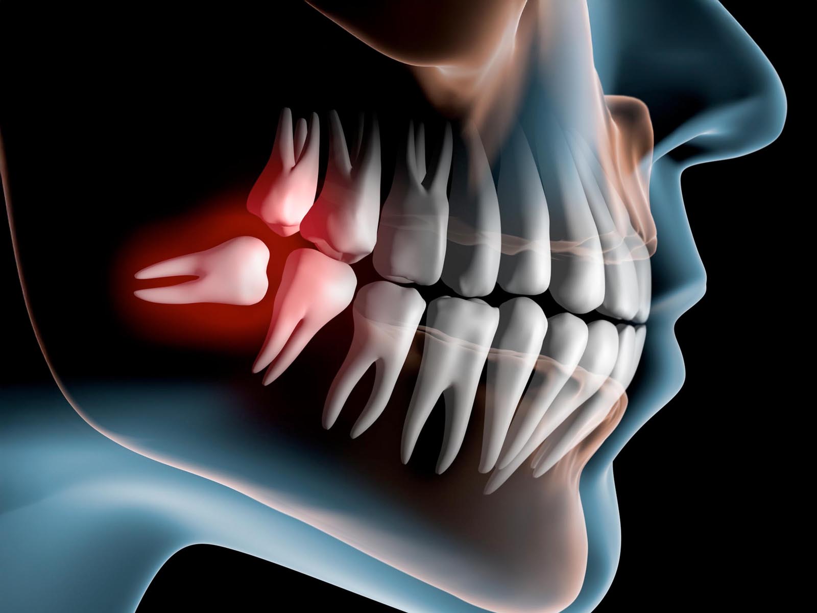 Wisdom Teeth Removal Services